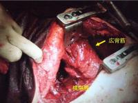 広背筋による横隔膜再建